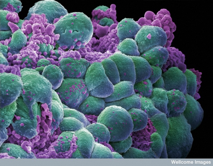 Breast Cancer Cells - false color scanning electron micrograph