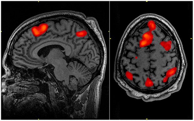 An fMRI scan highlights which portions of the brain are engaged in an activity or process.