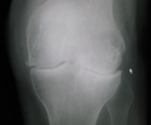 In this example of an arthritic knee, there is almost no cartilage left at the joint.